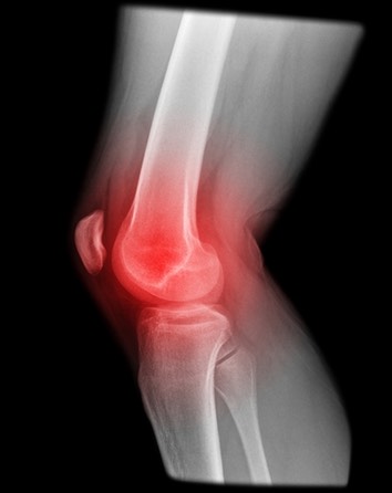 Knee Pain Picture