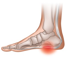 plantar-fasciitis